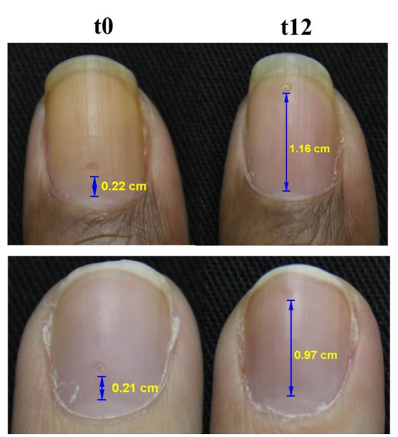 crescimento de unhas mais fortes e mais rápidas com o colágeno verisol beauty power da doTERRA